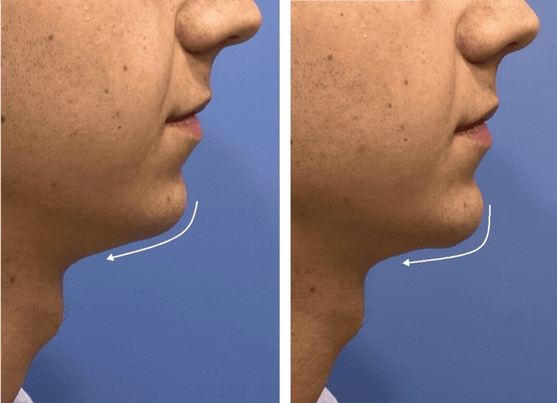 Mentoplastia caso 3 — antes y después